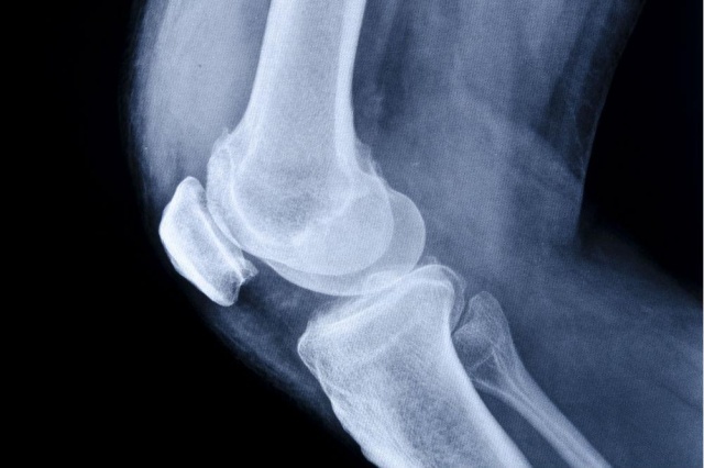 3D printed implants for knee